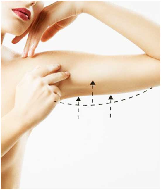 Arm Liposuction