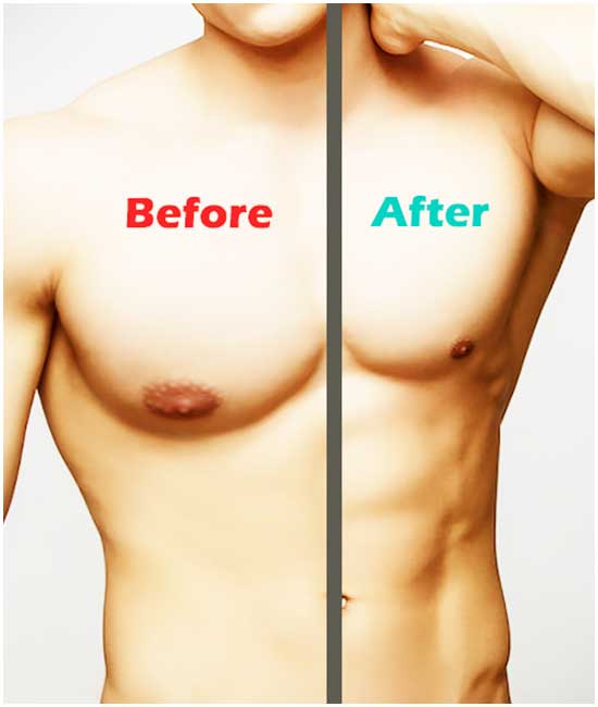 Liposuction Turkey before and after