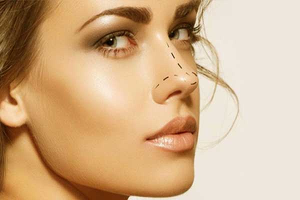 Rhinoplasty