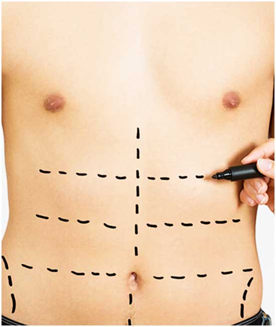 Liposuction