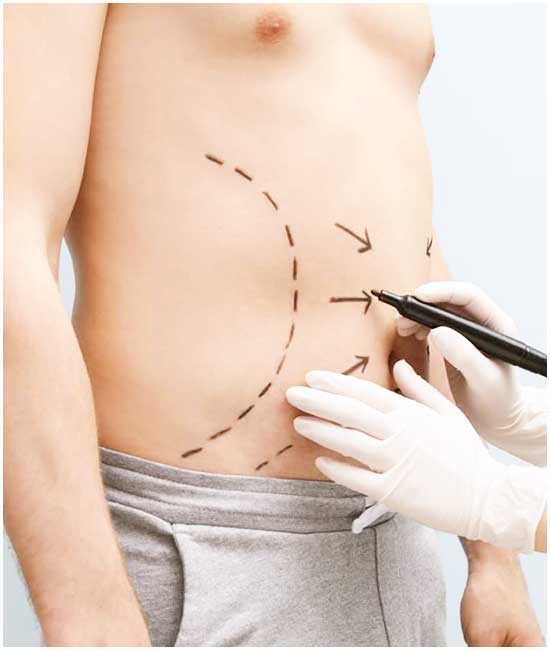 Abdominoplasty