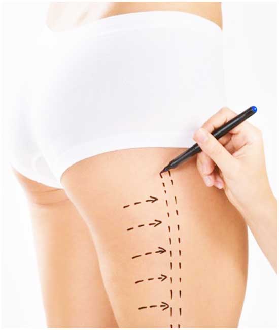 Thigh liposuction