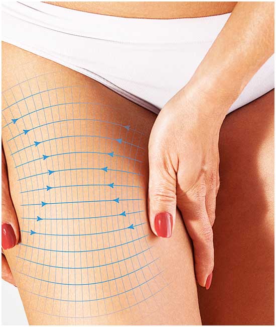 Laser Liposuction