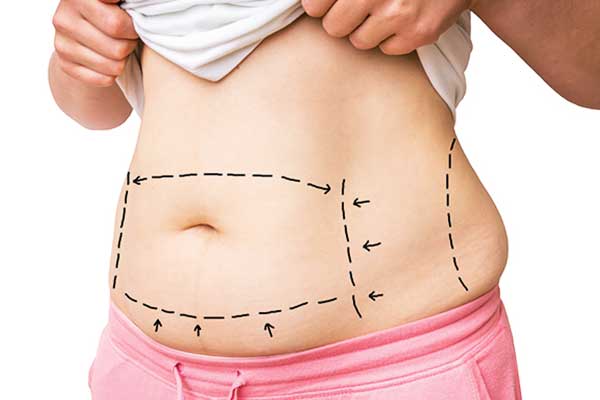 Tummy Tuck