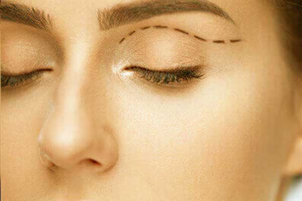 Eyelid Surgery