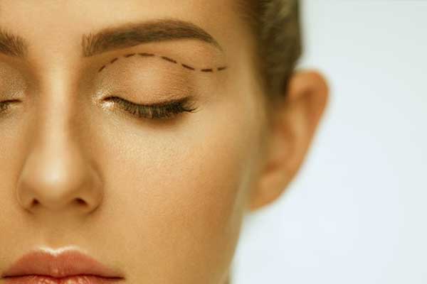 Blepharoplasty